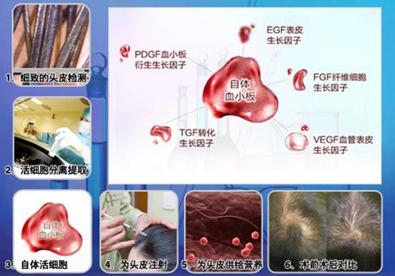 科發(fā)源的新傳奇：ST自體活細(xì)胞應(yīng)用